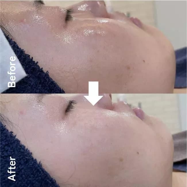 نمونه کار اکسیژن تراپی | Oxygen Facial - فیشیال و پاکسازی پوست شماره 3 در سالن تخصصی تهران