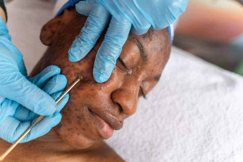 نمونه کار پاکسازی پوست آکنهدار | Acne Treatment - فیشیال و پاکسازی پوست شماره 2 در سالن تخصصی تهران